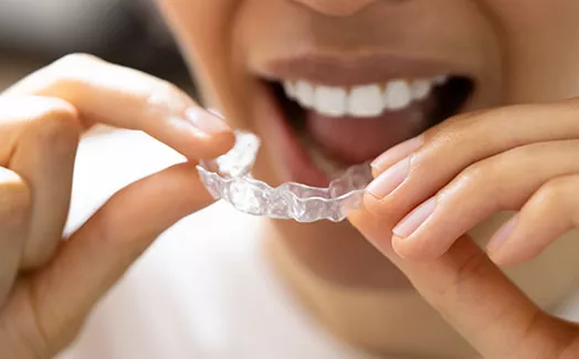 invisalign_0.jpg