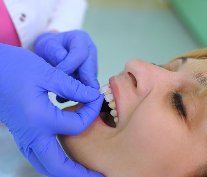 Veneers